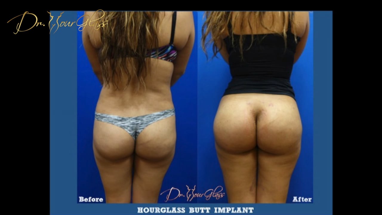 Butt Implants Images 42