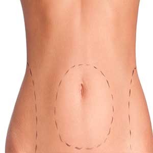 WORK AFTER LIPOSUCTION