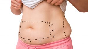Liposuction and obesity